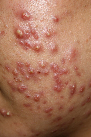 Acne