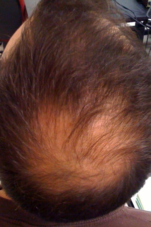 Alopecia