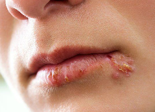 Cold Sore