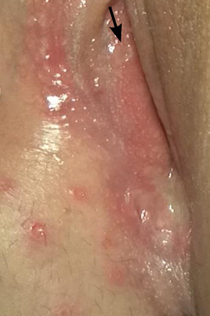 Genital Herpes