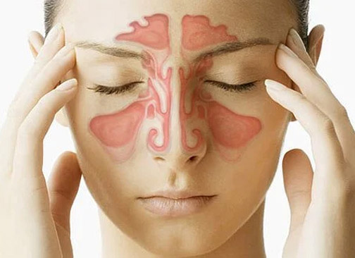 Sinus Infection